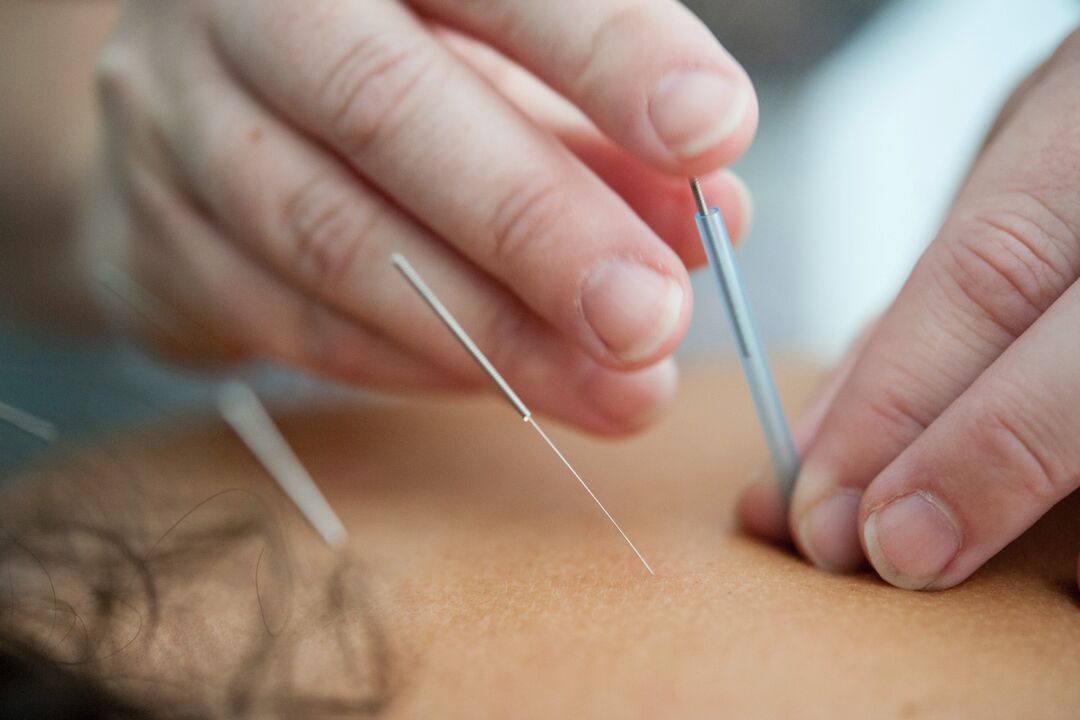Acupunctuur is een ineffectieve manier om te stoppen met roken