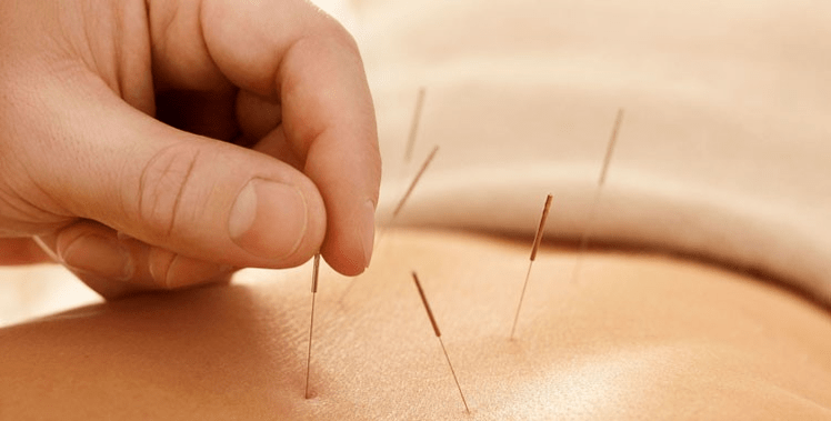 acupunctuur tegen roken
